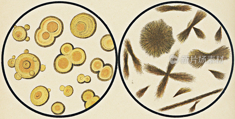 从尿液沉淀物- 19世纪的亮氨酸和酪氨酸晶体的显微镜观察